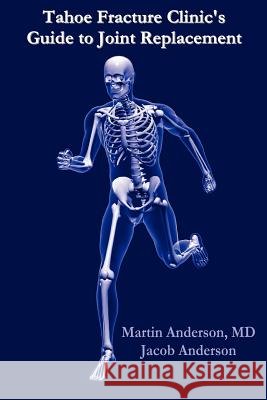 Tahoe Fracture Clinic's Guide to Joint Replacement Martin Anderson M.D. 9781430316732 Lulu.com - książka