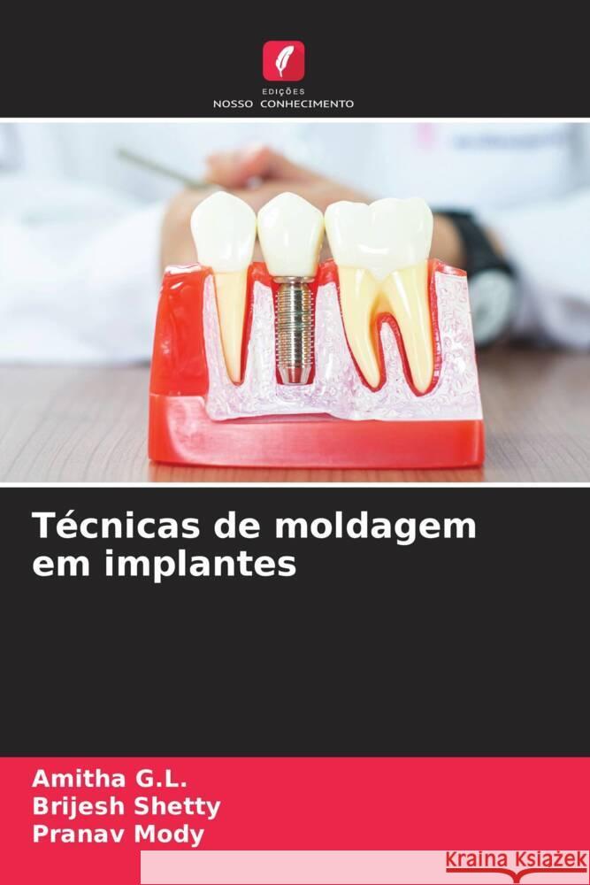 Técnicas de moldagem em implantes G.L., Amitha, Shetty, Brijesh, Mody, Pranav 9786206300137 Edições Nosso Conhecimento - książka