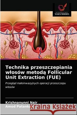 Technika przeszczepiania wlosów metodą Follicular Unit Extraction (FUE) Krishnanunni Nair, Amod Patankar 9786203536409 Wydawnictwo Nasza Wiedza - książka