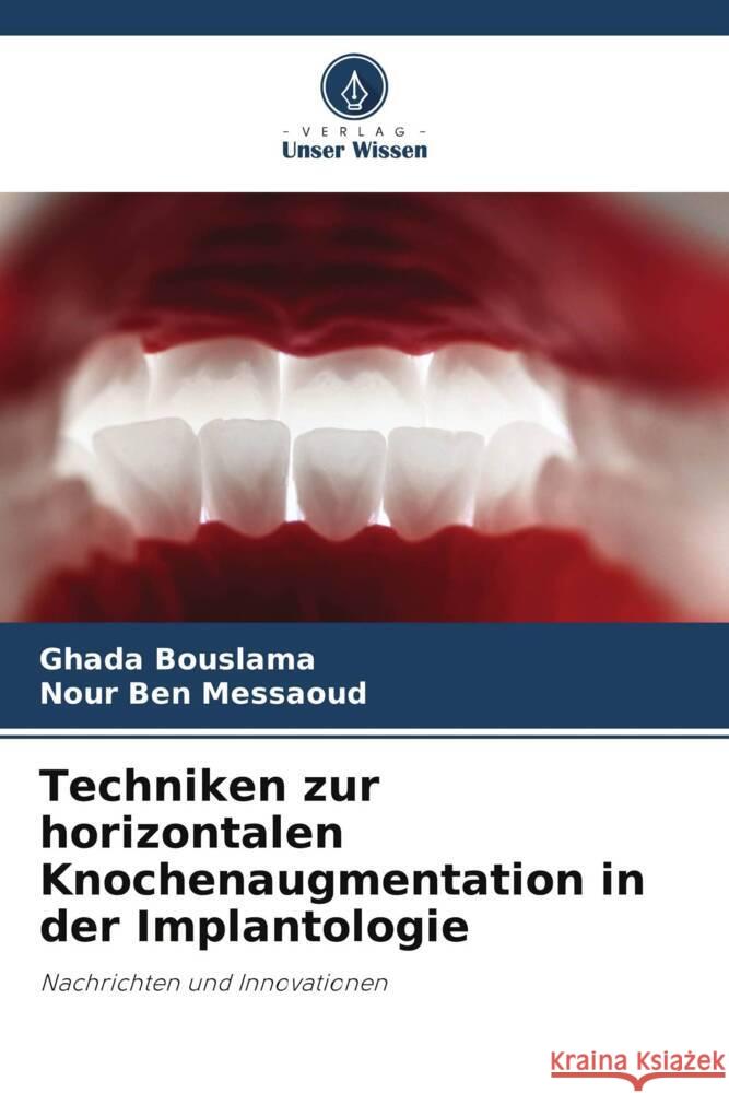 Techniken zur horizontalen Knochenaugmentation in der Implantologie Bouslama, Ghada, Ben Messaoud, Nour 9786208253585 Verlag Unser Wissen - książka