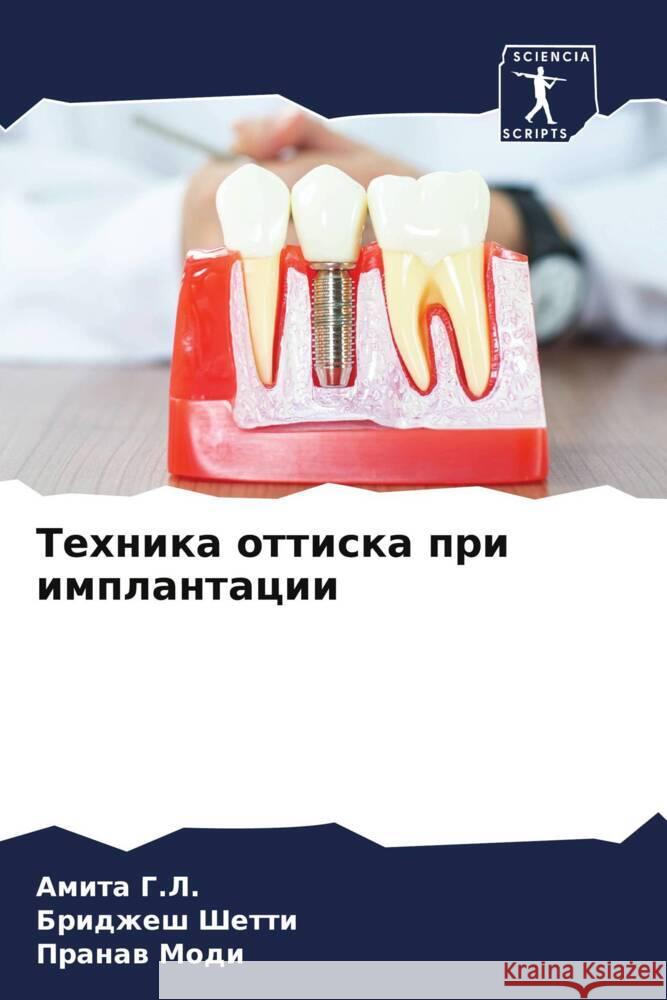 Tehnika ottiska pri implantacii G.L., Amita, Shetti, Bridzhesh, Modi, Pranaw 9786206300144 Sciencia Scripts - książka