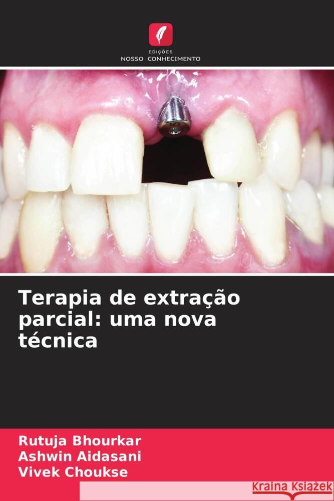 Terapia de extra??o parcial: uma nova t?cnica Rutuja Bhourkar Ashwin Aidasani Vivek Choukse 9786207972418 Edicoes Nosso Conhecimento - książka