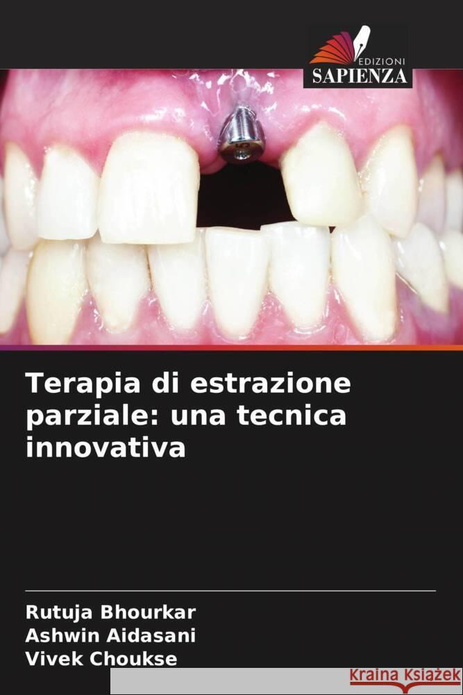 Terapia di estrazione parziale: una tecnica innovativa Rutuja Bhourkar Ashwin Aidasani Vivek Choukse 9786207972456 Edizioni Sapienza - książka