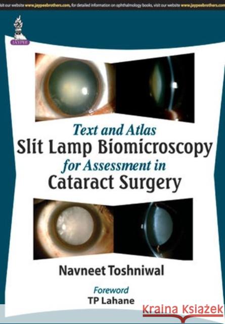 Text and Atlas: Slit Lamp Biomicroscopy for Assessment in Cataract Surgery Navneet Toshniwal   9789351523840 Jaypee Brothers Medical Publishers - książka