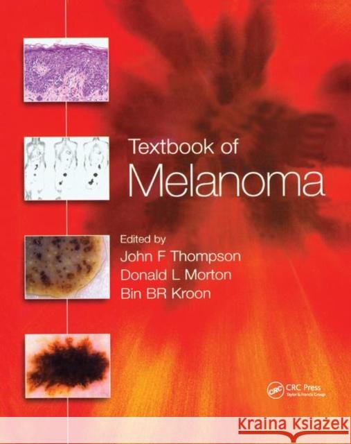 Textbook of Melanoma: Pathology, Diagnosis and Management John F. Thompson Donald L. Morton Bin B. R. Kroon 9780367394974 CRC Press - książka