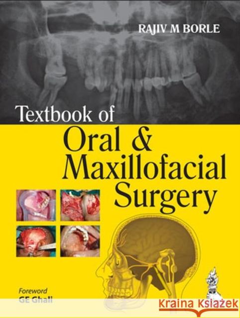 Textbook of Oral and Maxillofacial Surgery Rajiv M Borle 9789351520092 JP Medical Ltd - książka