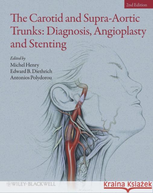 The Carotid and Supra-Aortic Trunks: Diagnosis, Angioplasty and Stenting Henry, Michel 9781405198547  - książka