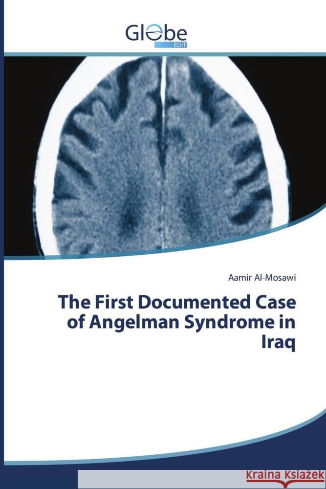 The First Documented Case of Angelman Syndrome in Iraq Al-Mosawi, Aamir 9786209099779 GlobeEdit - książka