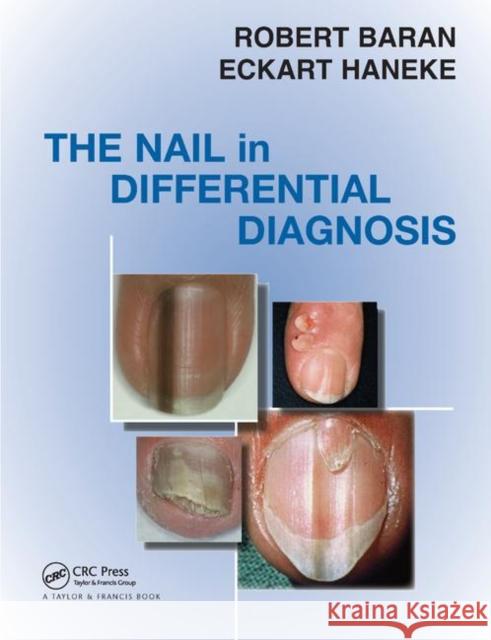 The Nail in Differential Diagnosis Robert Baran Eckart Haneke 9780367389741 CRC Press - książka