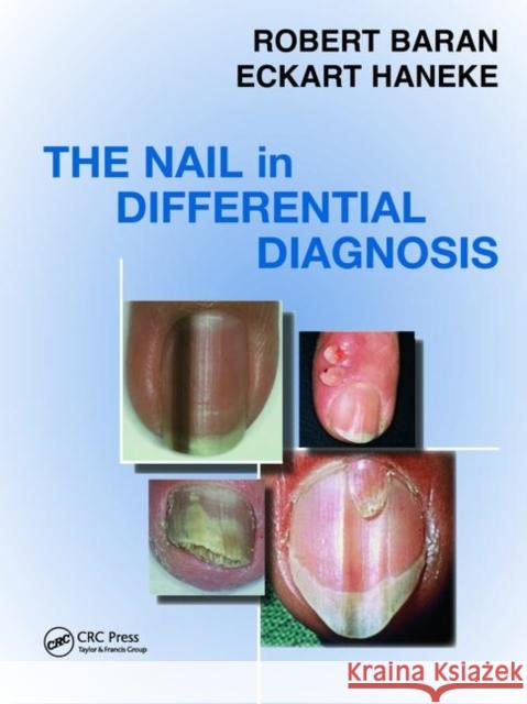 The Nail in Differential Diagnosis Baran, Robert 9781841845067 Informa Healthcare - książka