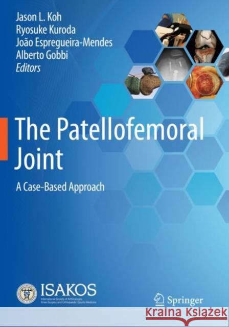 The Patellofemoral Joint: A Case-Based Approach Jason L. Koh Ryosuke Kuroda Jo?o Espregueira-Mendes 9783030815479 Springer - książka