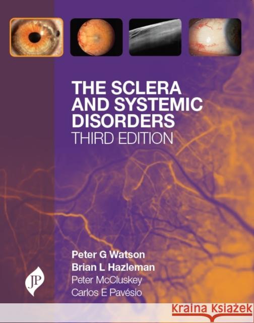 The Sclera and Systemic Disorders Peter G Watson 9781907816079  - książka