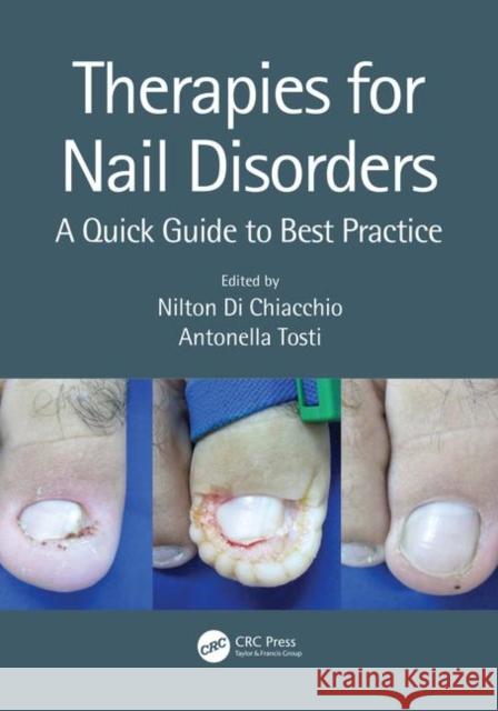 Therapies for Nail Disorders: A Quick Guide to Best Practice Nilton D Antonella Tosti 9781138370364 CRC Press - książka