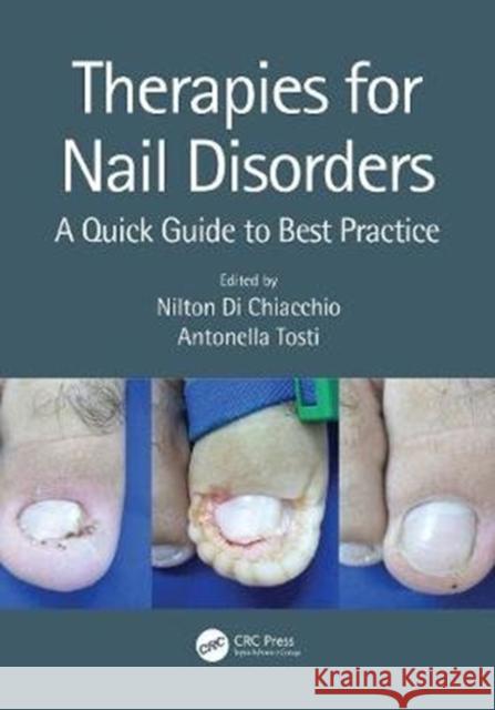 Therapies for Nail Disorders: A Quick Guide to Best Practice Nilton D Antonella Tosti 9781138370395 CRC Press - książka