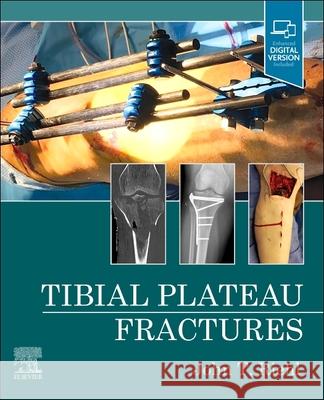 Tibial Plateau Fractures John Riehl 9780323825689 Elsevier - książka