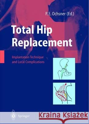 Total Hip Replacement: Implantation Technique and Local Complications Hinchliffe, R. 9783642628689 Springer - książka