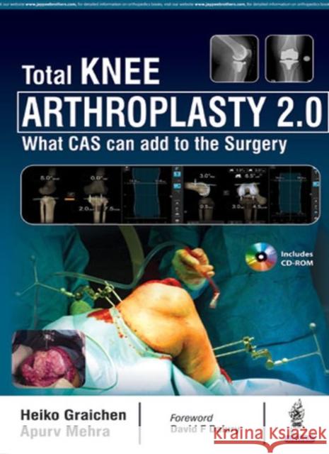 Total Knee Arthroplasty 2.0: What Cas Can Add to the Surgery Heiko Graichen 9789352703487 Jp Medical Ltd - książka