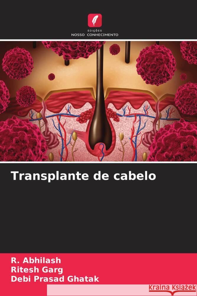 Transplante de cabelo R. Abhilash Ritesh Garg Debi Prasad Ghatak 9786206994886 Edicoes Nosso Conhecimento - książka