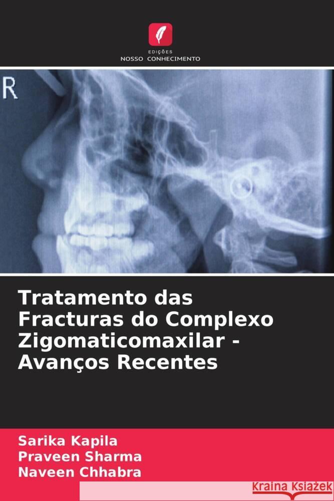 Tratamento das Fracturas do Complexo Zigomaticomaxilar - Avan?os Recentes Sarika Kapila Praveen Sharma Naveen Chhabra 9786207247349 Edicoes Nosso Conhecimento - książka