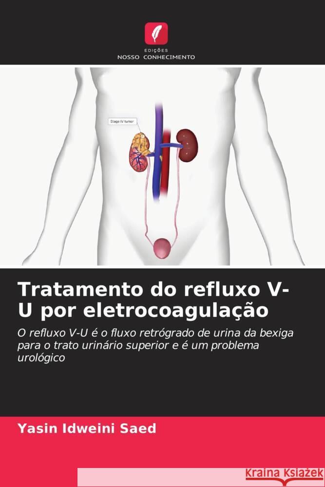 Tratamento do refluxo V-U por eletrocoagulação Saed, Yasin Idweini 9786206879589 Edições Nosso Conhecimento - książka