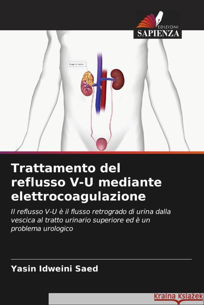 Trattamento del reflusso V-U mediante elettrocoagulazione Saed, Yasin Idweini 9786206879572 Edizioni Sapienza - książka