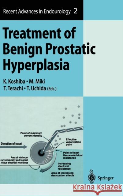 Treatment of Benign Prostatic Hyperplasia K. Koshiba M. Miki T. Terachi 9784431702849 Springer Japan - książka