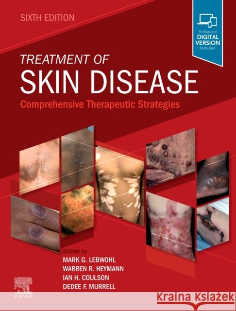 Treatment of Skin Disease: Comprehensive Therapeutic Strategies Mark G. Lebwohl Warren R. Heymann Ian Coulson 9780702082108 Elsevier Health Sciences - książka