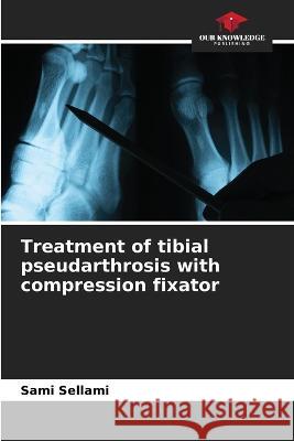 Treatment of tibial pseudarthrosis with compression fixator Sami Sellami   9786206209928 Our Knowledge Publishing - książka