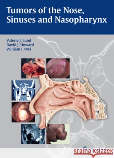 Tumors of the Nose, Sinuses and Nasopharynx Valerie J. Lund 9783131471918 Thieme Medical Publishers - książka