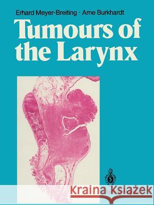 Tumours of the Larynx: Histopathology and Clinical Inferences Meyer-Breiting, Erhard 9783642711022 Springer - książka