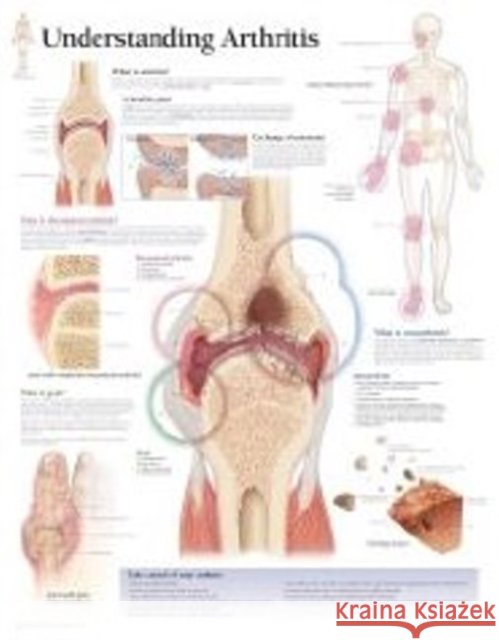 Understanding Arthritis Laminated Poster Scientific Publishing 9781932922202 Scientific Publishing - książka