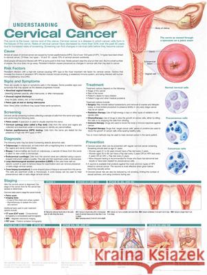 UNDERSTANDING CERVICAL CANCER ANATOMICAL ANATOMICAL CHART COM 9781975192334 LIPPINCOTT WILLIAMS & WILKINS - książka