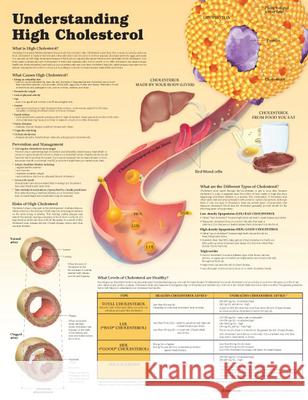 Understanding High Cholesterol Paper Anatomical Chart Company Douglas S. Moodie  9781451193251 Lippincott Williams and Wilkins - książka