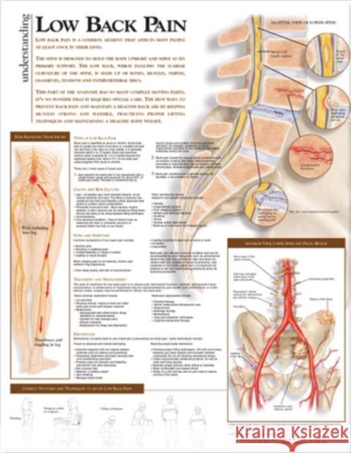 Understanding Low Back Pain Anatomical Chart  Anatomical Chart Company 9780781782425  - książka