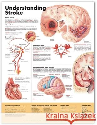 Understanding Stroke Anatomical Chart Anatomical Chart Company 9781587799877 Lippincott Williams & Wilkins - książka