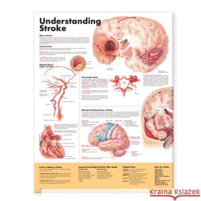 Understanding Stroke Anatomical Chart  Anatomical Chart Company 9781587799884  - książka