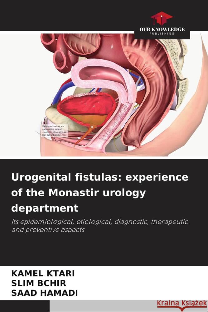 Urogenital fistulas: experience of the Monastir urology department Ktari, Kamel, BCHIR, SLIM, HAMADI, SAAD 9786206521136 Our Knowledge Publishing - książka