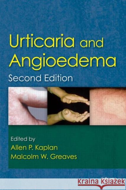 Urticaria and Angioedema Allen Kaplan Malcolm W. Greaves 9781420077841 Informa Healthcare - książka