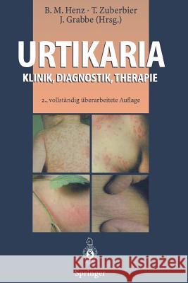 Urtikaria: Klinik, Diagnostik, Therapie Henz, Beate M. 9783642852428 Springer - książka