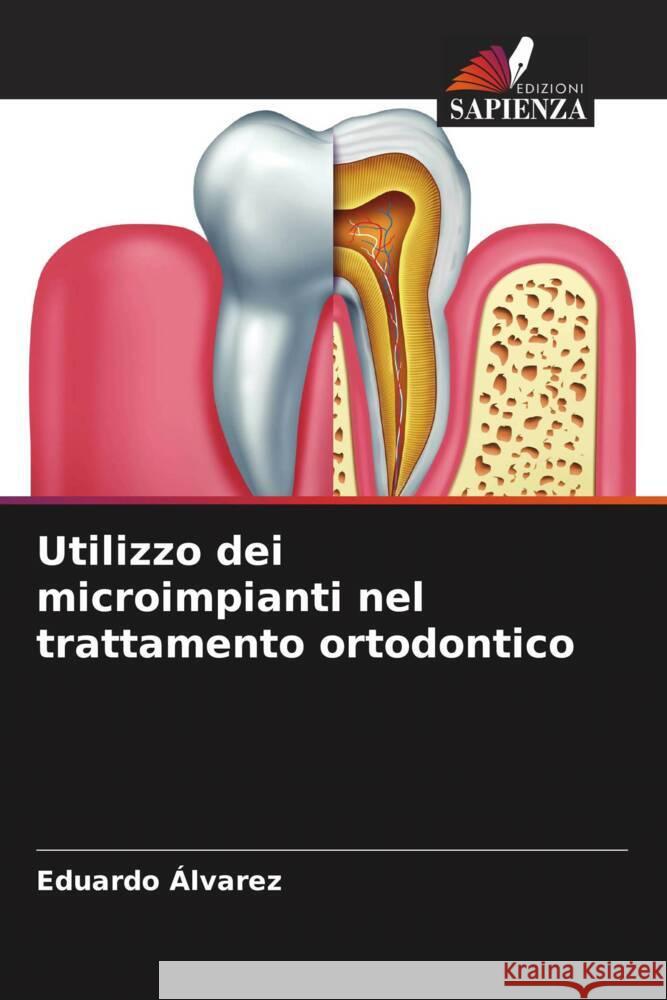 Utilizzo dei microimpianti nel trattamento ortodontico Eduardo ?lvarez 9786207057665 Edizioni Sapienza - książka