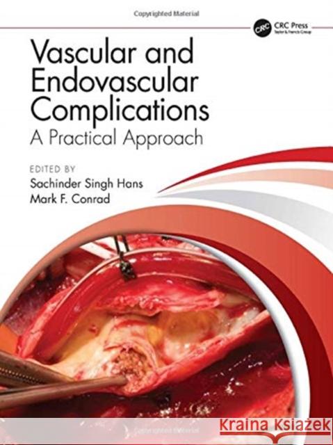 Vascular and Endovascular Complications: A Practical Approach: A Practical Approach Hans, Sachinder Singh 9781138352933 CRC Press - książka