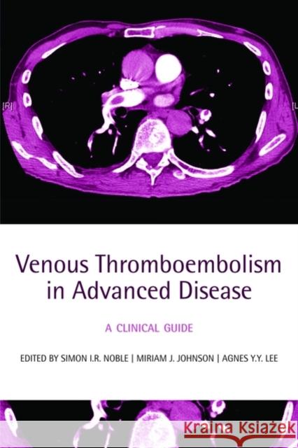 Venous Thromboembolism in Advanced Disease: A Clinical Guide Noble, Simon I. R. 9780199232048 Oxford University Press, USA - książka