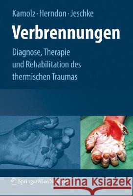 Verbrennungen: Diagnose, Therapie Und Rehabilitation Des Thermischen Traumas Kamolz, Lars-Peter 9783211798959 Springer, Wien - książka