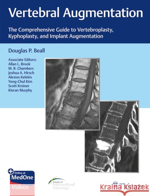 Vertebral Augmentation: The Comprehensive Guide to Vertebroplasty, Kyphoplasty, and Implant Augmentation Beall, Douglas P. 9781684200153 Thieme Medical Publishers - książka