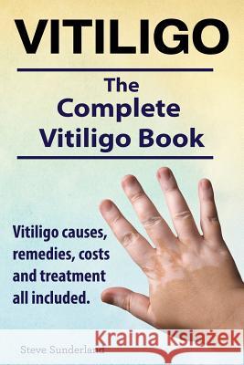 Vitiligo. Vitiligo causes, remedies, costs and treatment all included. The complete Vitiligo Book. Sunderland, Steve 9781910410844 Imb Publishing - książka