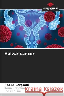 Vulvar cancer Hayfa Bergaoui Toumi Dhekra Ines Zouari 9786207600243 Our Knowledge Publishing - książka