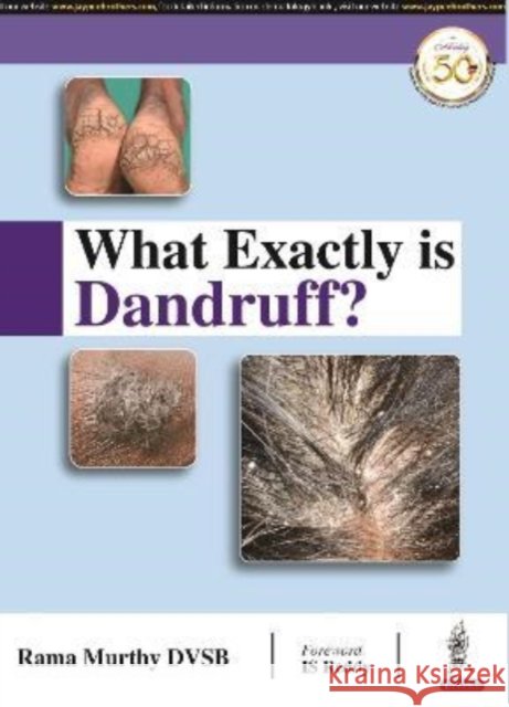 What Exactly is Dandruff? Rama Murthy DVSB   9789351522379 Jaypee Brothers Medical Publishers - książka