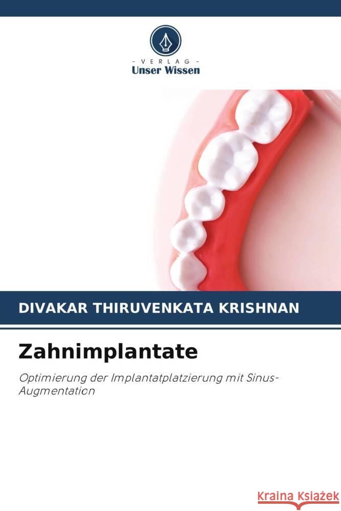 Zahnimplantate Divakar Thiruvenkata Krishnan   9786206001515 Verlag Unser Wissen - książka