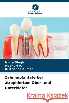 Zahnimplantate bei atrophiertem Ober- und Unterkiefer Singh, Ishita, V., Madhuri, Kumar, U. Krishna 9786203919356 Verlag Unser Wissen - książka