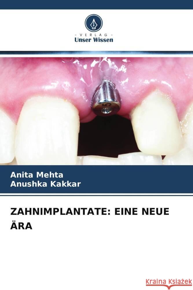 ZAHNIMPLANTATE: EINE NEUE ÄRA Mehta, Anita, Kakkar, Anushka 9786205453087 Verlag Unser Wissen - książka